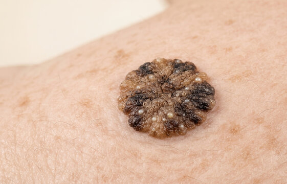 Macro close-up of a dark, raised, warty skin lesion on human skin, characteristic of seborrheic keratosis or a suspect melanoma.