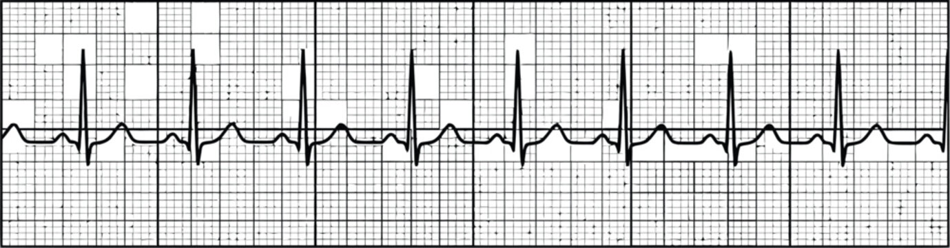 Black heart rate line showing normal sinus rhythm on a medical ekg graph paper