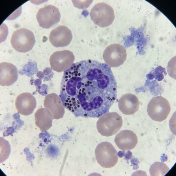 Highly realistic light microscopy photograph of a neutrophil showing toxic granulation in a peripheral blood smear
