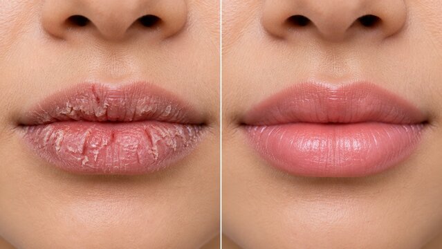 AI generated comparison of chapped dry lips before and after hydration treatment for smooth healthy skin.