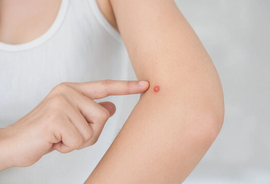 Close Up of Woman Inspecting Red Mosquito Bite on Arm, Insect Bite and Skin Irritation Concept