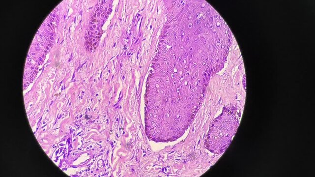 Fibroepithelial cyst in the groin area, also known as a fibroepithelial polyp (FEP), a common, benign, and usually harmless growth of skin and tissue.