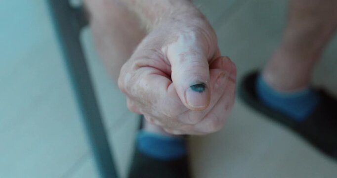 Close-up of a thumb showing dark blue discoloration under the fingernail