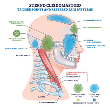 Sternocleidomastoid trigger points and referred pain patterns on a head profile, highlighting SCM muscle, trigger points, and shaded pain zones across head, face, and ear. Outline diagram