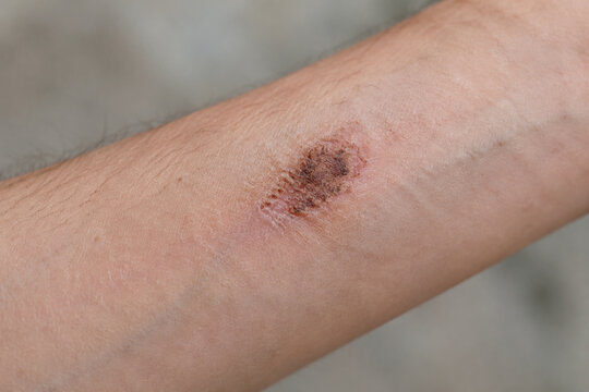 Healing scrape with scab on forearm, recovery and skin care concept