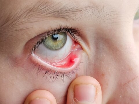 Closeup little girl one eye infection isolated on white background, eyelid abscess hordeolum. Concept of health, disease