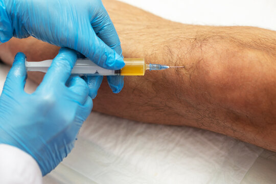 Knee joint plasma therapy. Patient's own biomaterial. Treatment of joint pain without surgery. Doctor injects plasma into patient's knee. Top view