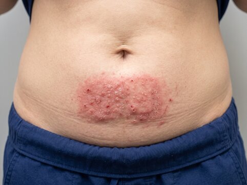 &ldquo;Belt Buckle Allergy: Localized Allergic Contact Dermatitis&rdquo;