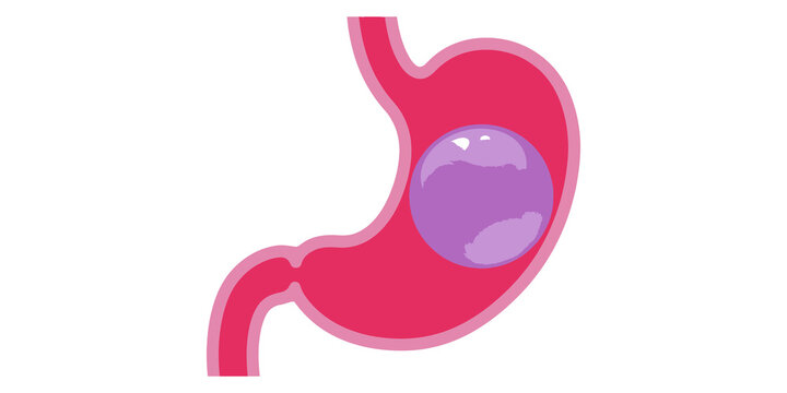 Anatomical human stomach illustration with intragastric balloon for medical and weight loss procedures.