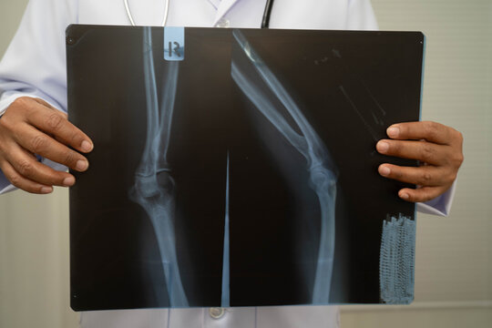 Doctor examining knee joint bone radiography xray film.