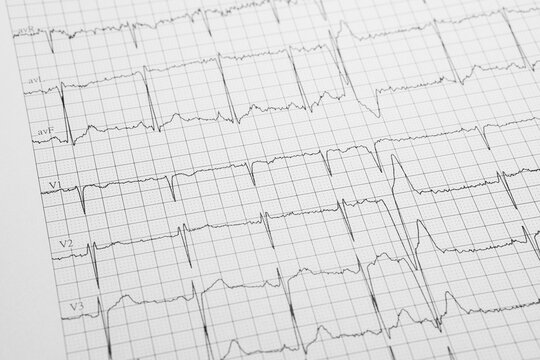 Close-Up of Electrocardiogram Tracing on Medical Grid Paper. Detailed close-up of an ECG printout showing multiple cardiac waveform leads on grid paper for heart rhythm monitoring and medical analysis