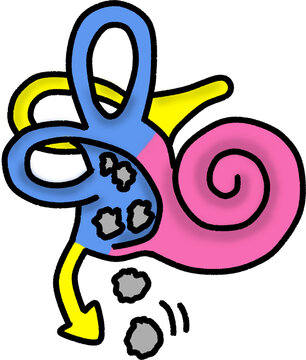 Vector illustration of inner ear anatomy showing benign paroxysmal positional vertigo (BPPV) and otoliths dislodgement