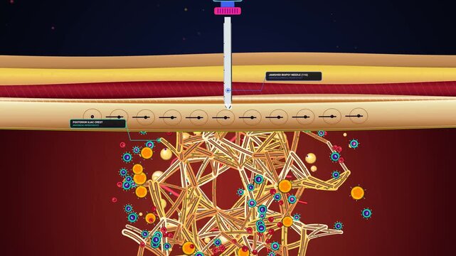 2D animation showing the medical procedure of bone marrow aspiration from the posterior iliac crest to harvest hematopoietic stem cells using a biopsy needle and syringe