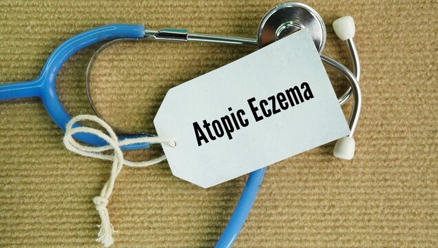 Stethoscope and paper tag with the word Atopic eczema. common, long-term skin condition that makes your skin dry, red, and very itchy. It is not contagious, and it often starts in childhood.