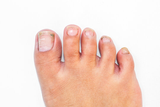 Closeup of an adult foot with long, untrimmed toenails and visible dirt beneath the nails, showing poor foot hygiene and neglected nail care isolated on white background. Ingrown toenails full of dirt