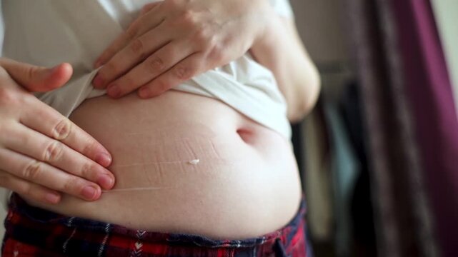 Woman applying moisturizing lotion dispenser cream on stretch marks on belly skin. Close up of female hands caring for stomach body skin.