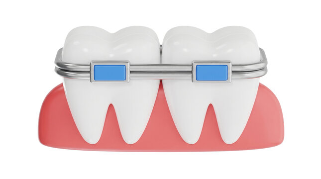 Dental braces on human teeth with blue brackets and metal wire over pink gums for orthodontic treatment illustration.