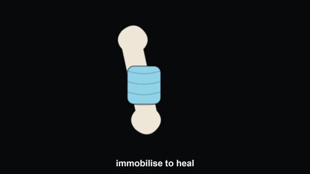 Animated Broken Bone Fracture with Medical Cast