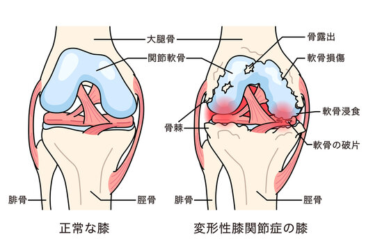 膝関節のしくみ　正常な膝と変形性膝関節症の膝