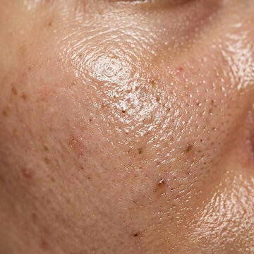 Close-up of oily female facial skin with visible shiny sheen, enlarged pores, blackheads, and acne inflammation on the cheek area.