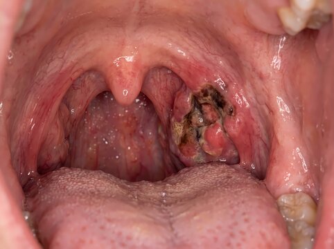Macro view of a necrotic tumor on the tonsil inside a human mouth, suggestive of oropharyngeal cancer or severe infection