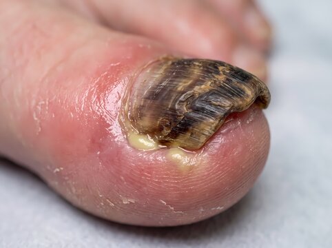 Close-up of a severely infected human toenail with fungal growth, inflammation, and pus discharge