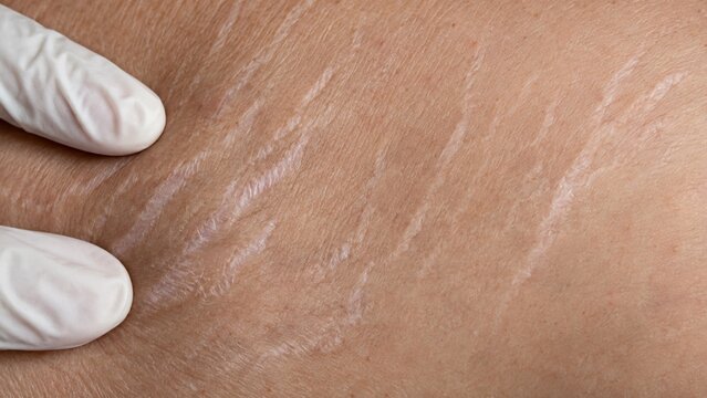 Mature Silver Stretch Marks on Adult Skin

