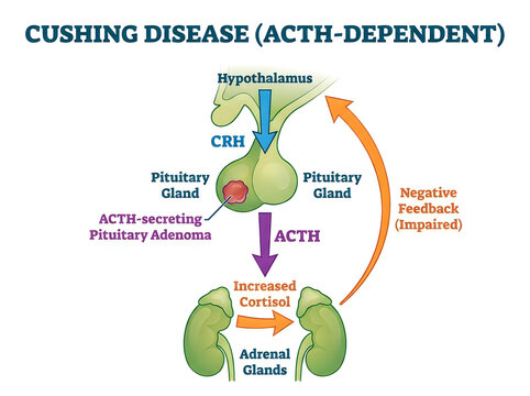 Cushing Disease ACTH Dependent Medical Infographic Showing Pituitary Adenoma Adrenal Cortisol Pathway and Impaired Negative Feedback Diagram