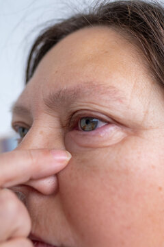 female eye with visible redness, severe swelling, Clinical observation periorbital edema, inflammatory process, allergic or infectious eye condition, ocular inflammation and trauma, blepharitis