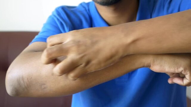 Close up of man scratching arm experiencing itch discomfort or skin irritation