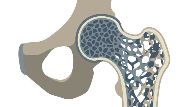 Hip joint anatomy illustrating femoral head and acetabulum internal bone matrix flat vector graphic for orthopedic clinical education