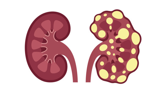 Polycystic kidney disease pathology versus healthy renal function flat vector illustration for urological health infographics