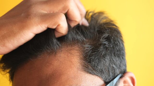 Man examining receding hairline and hair loss problems close up on yellow background