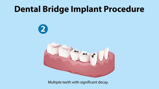 Dental bridge implant procedure with detailed visual steps of healthy teeth gums multiple teeth significant decay decayed teeth removed dental implant abutment screws attached jaw 