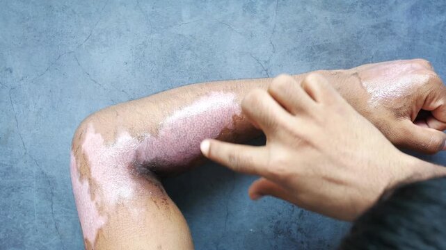 Person examining skin with vitiligo symptoms on arm and elbow area for medical observation and diagnosis