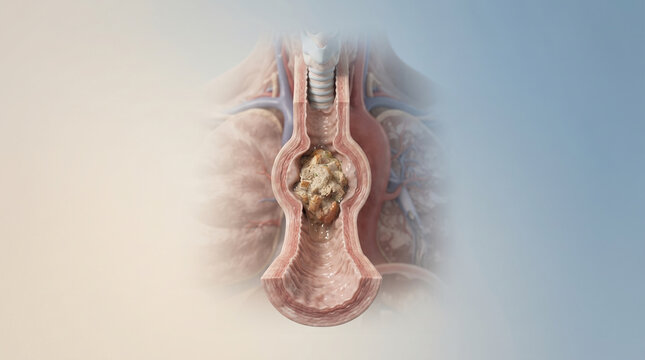Medical illustration shows blockage in the esophagus with food impaction
