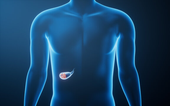 Medical 3D illustration of gallbladder stone, 3d rendering.