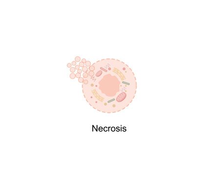 Necrosis, Pathologic Cell Death, Death of the body tissues, Cell injury which results in the premature death of cells in living tissue by autolysis.