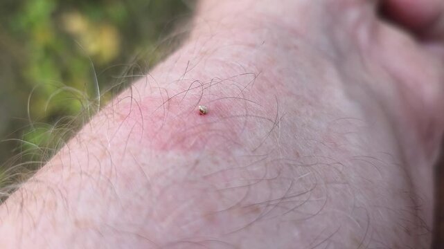 The bee left a sting with a vial of poison in the mans skin. The bubble contracts and delivers poison through the sting into the body of the animal that attacked the bee.