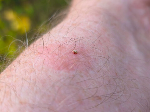 The bee left a sting with a vial of poison in the mans skin.