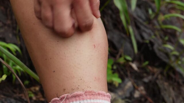 Close up of hiker scratching itchy leg from black fly insect bites and rash while hiking in forest