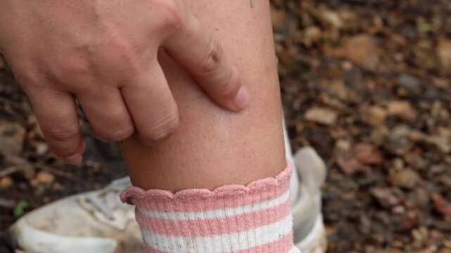 Close up of applying soothing ointment cream to treat itchy black fly insect bites on lower leg outdoors