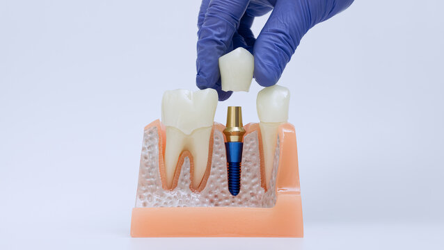 Dental implant crown placement with gloved hand positioning prosthetic tooth over abutment on anatomical jaw model