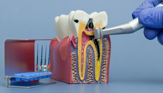 Endodontics concept. Educational anatomical model of a tooth with deep caries and pulpitis treatment demonstration.