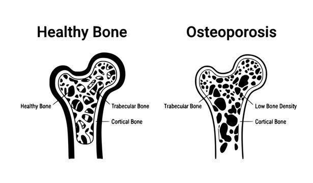 Osteoporosis Low Bone Density Healthy and Fragile Bone Cross Section Medical Vector Illustration