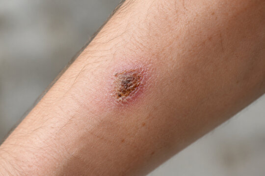 Healing scrape with scab on forearm, recovery and skin care concept