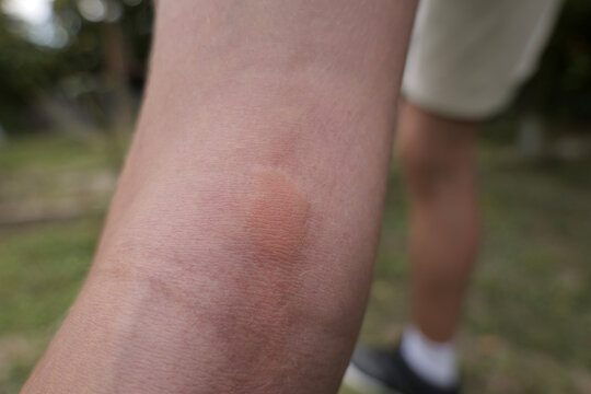 Person showing red mosquito bite allergic reaction on skin