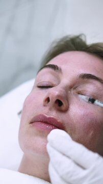 Vertical video. Lips injection. Facial procedure. Female professional cosmetologist hands in white gloves using dermal product in aesthetic salon.
