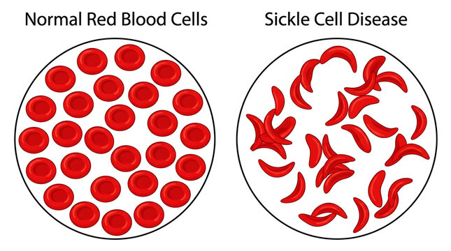 Normal red blood cells and sickle cell disease comparison