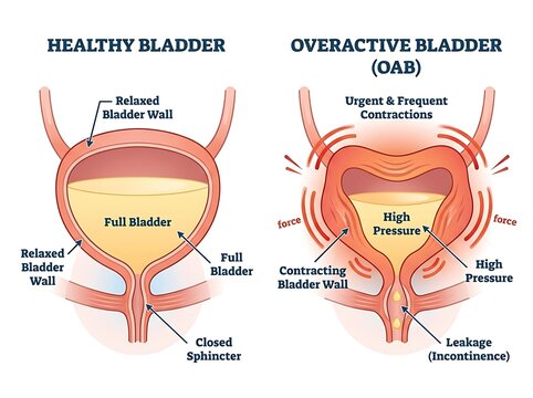 Diagram comparing healthy bladder function and overactive bladder oab